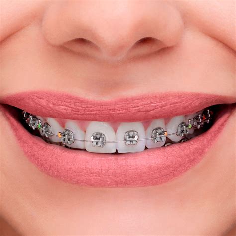 precio de brackets metalicos españa|brackets de autoligado.